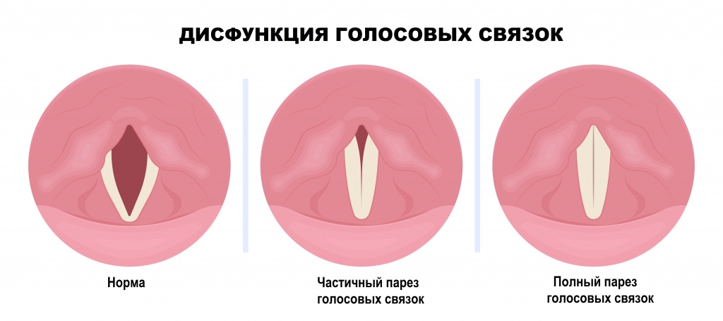 Спазм голосовых связок.jpg