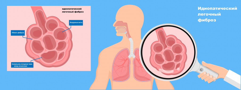 Лечение фиброза у мужчин. Какой врач лечит фиброз легких. Идиопатический фиброз легких, гепатит в, СПИД. Процесс заболевания фибриозом.