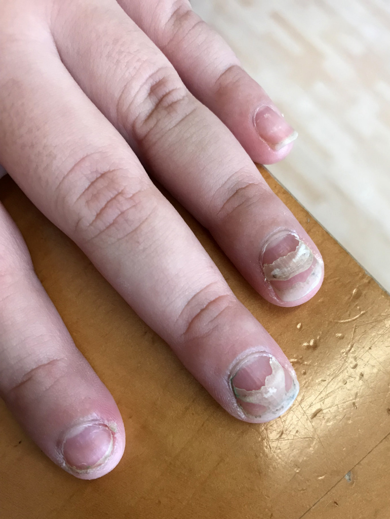 Почему могут слезать ногти у ребёнка?