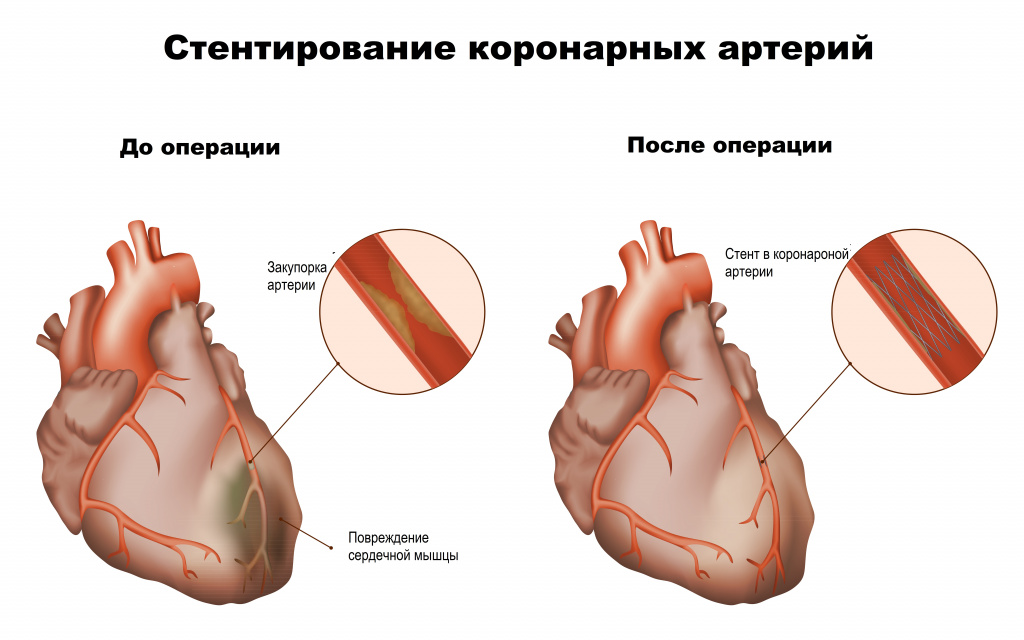 Хроническая ишемическая болезнь сердца стенокардия диагностика тесты нмо