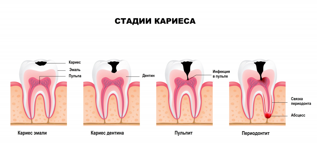 Стадии кариеса.jpg Стадии кариеса.jpg