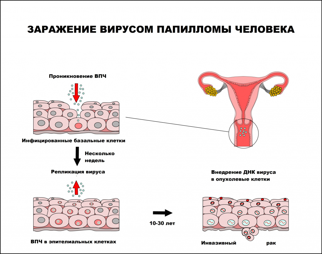 Humani papiloma virus simptomi kod zena. Hpv virus kod muskaraca lijecenje