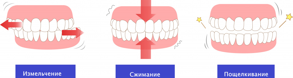 Виды бруксизма.jpg