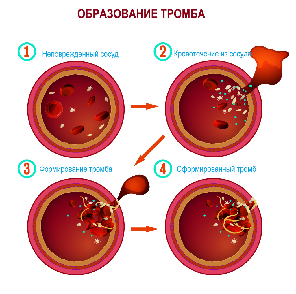 Геморрагический синдром.jpg