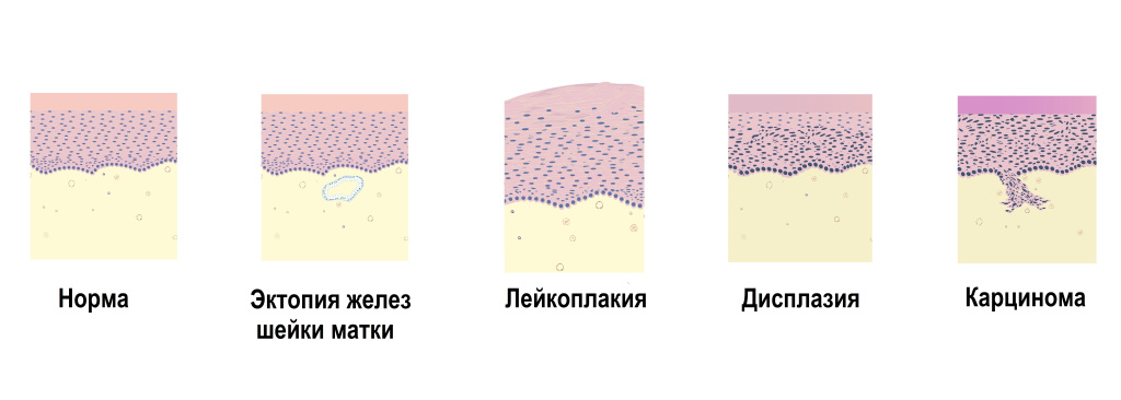 Лейкоплакия.jpg