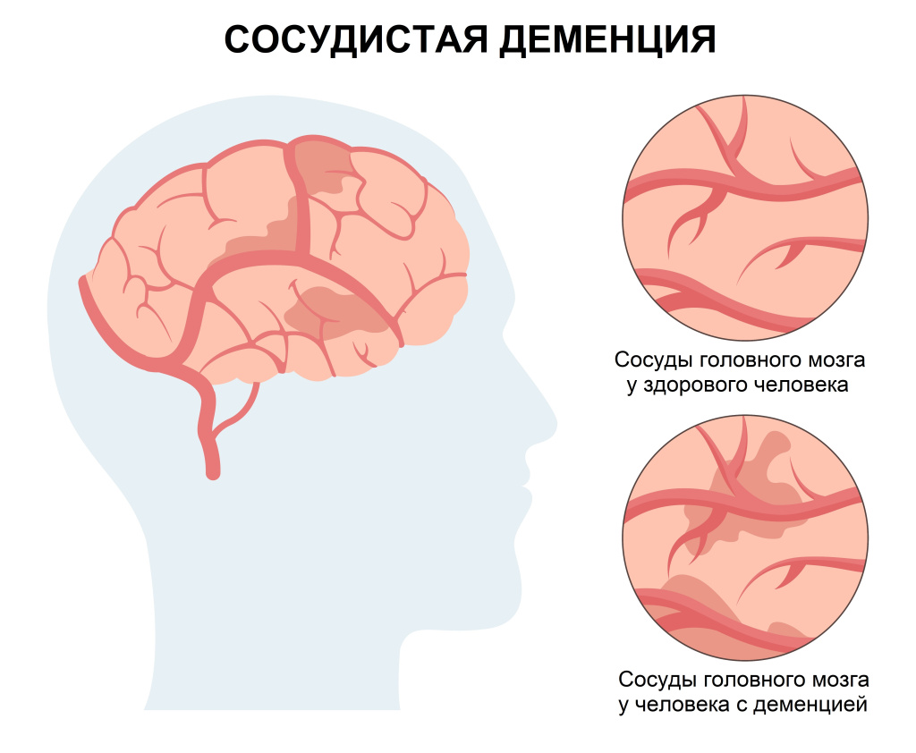 Дисциркуляторная энгцефалопатия.jpg