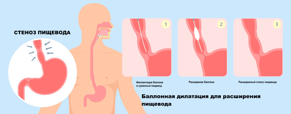Стеноз пищевода.jpg