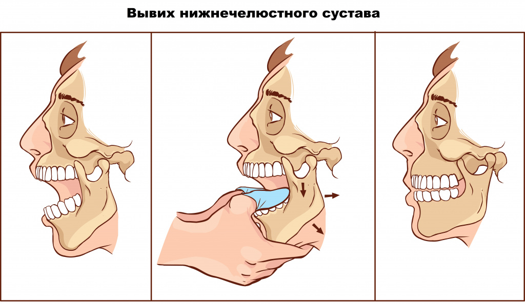 Вывих челюсти.jpg Вывих челюсти.jpg