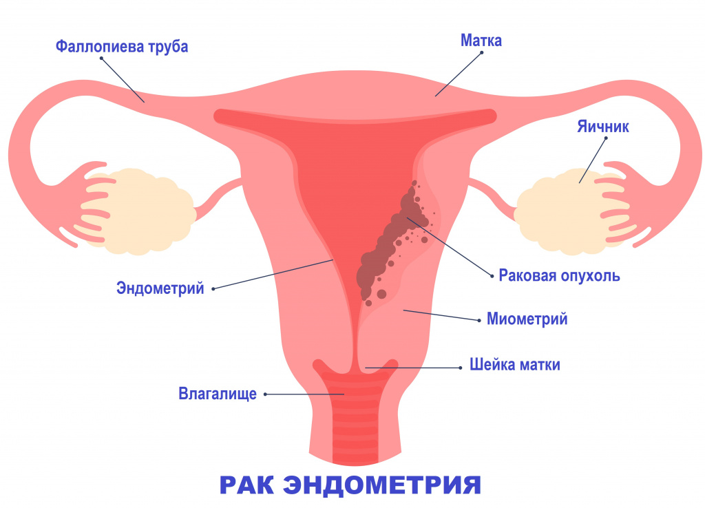 Симптомы эндометриоидной аденокарциномы матки: