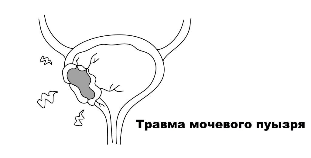 Травма МП.jpg