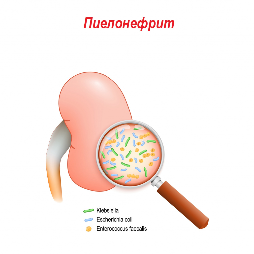 Пиелонефрит.jpg
