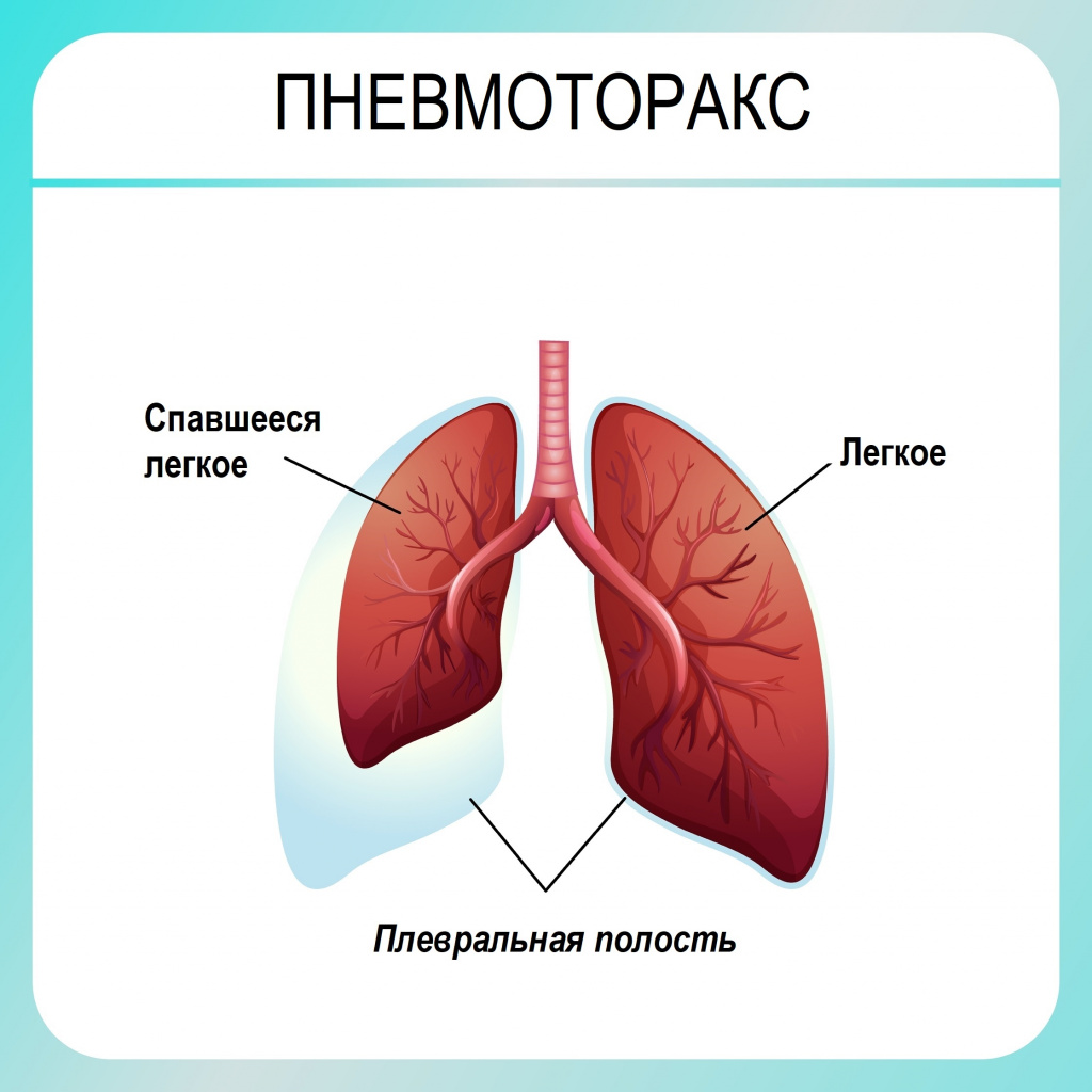 Пневмоторакс - причины появления, при каких заболеваниях возникает,  диагностика и способы лечения