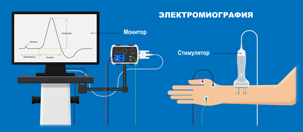 Электромиография.jpg