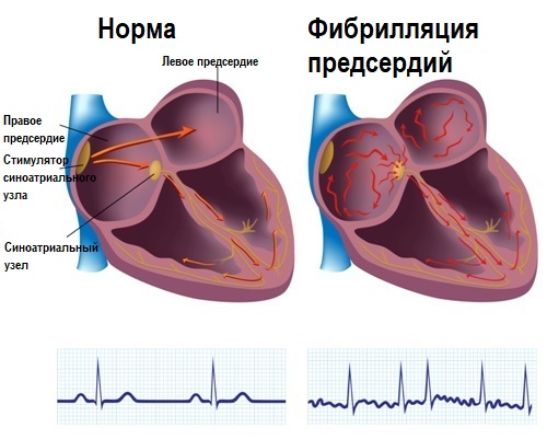 Аритмия.jpg