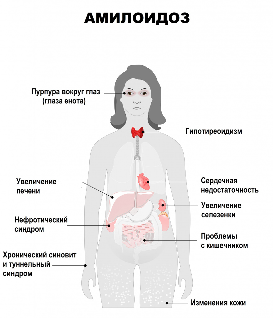 Амилоидоз симптомы.jpg