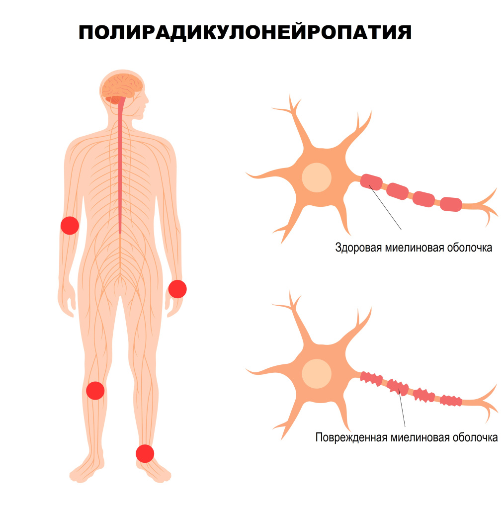 Полирадикулонейропатия.jpg