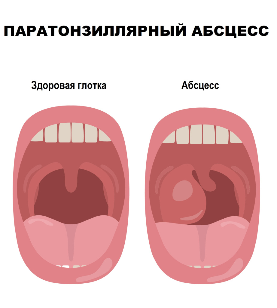 Абсцесс.jpg