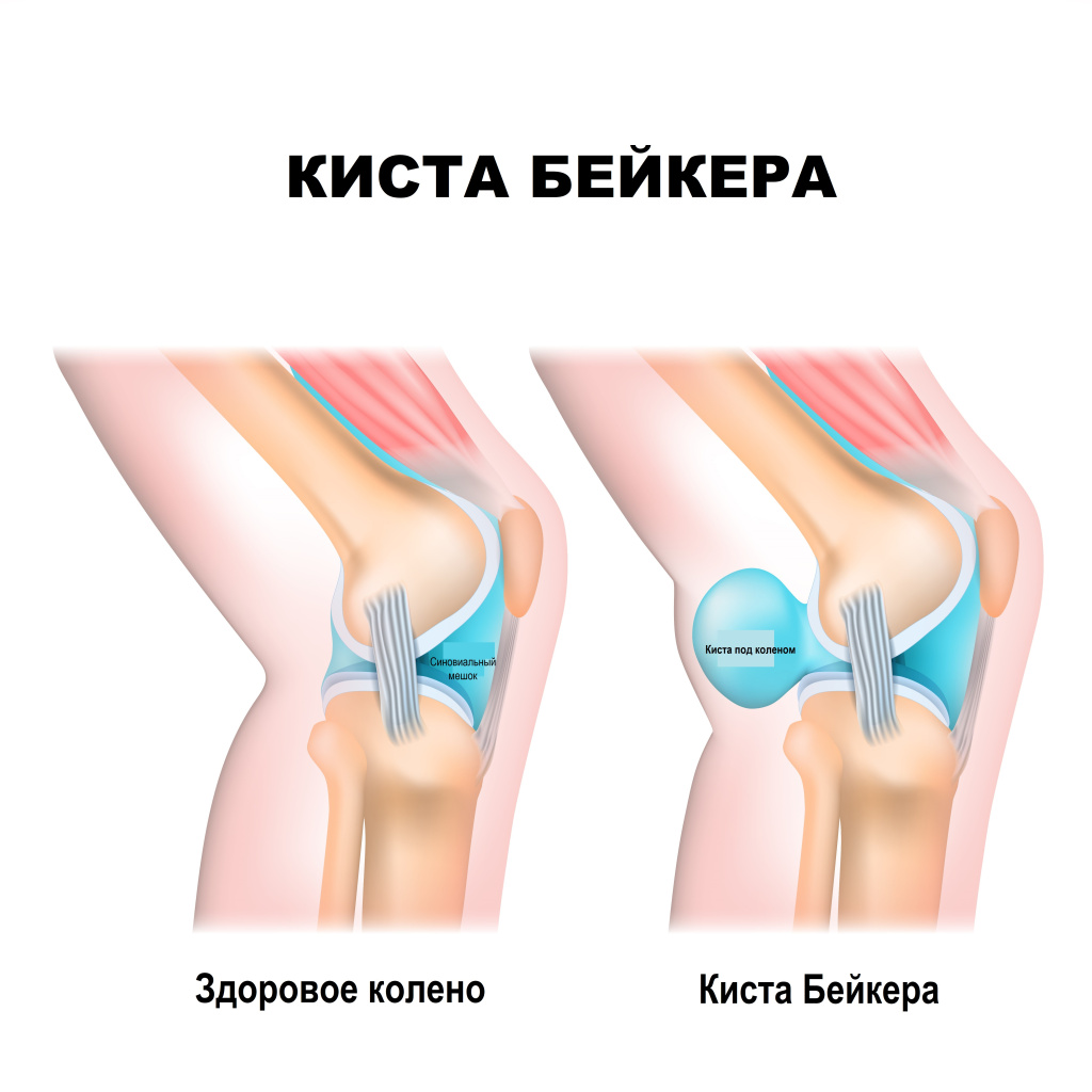 Киста.jpg