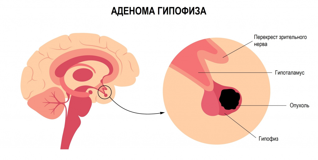 Опухоль гипофиза.jpg