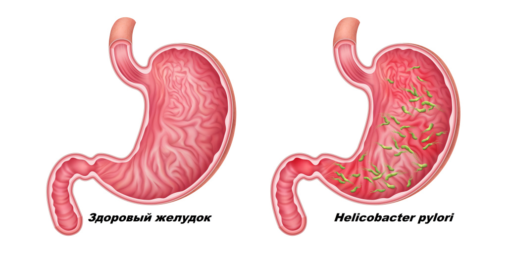 Heliсobacter pуlori.jpg