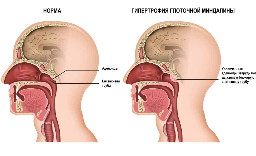 Аденоиды.jpg