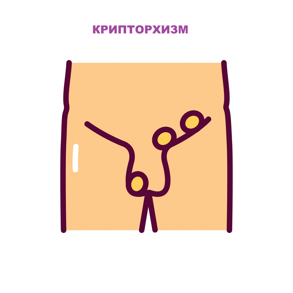Крипторхизм.jpg