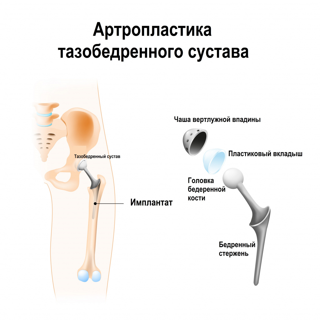 liječenje sol artroze ileck)