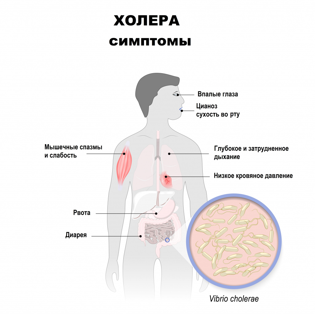 Симптомы холеры.jpg