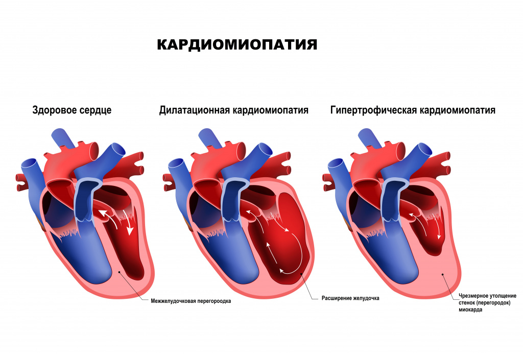 Кардиомиопатия болезнь.jpg