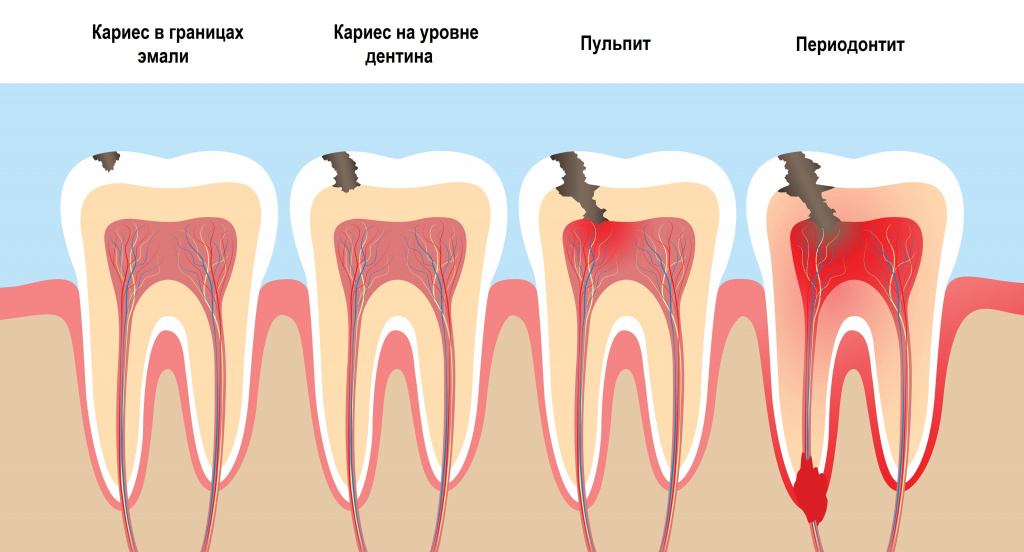 Лечение периостита Томск Даниловский стоматология фабрика улыбок томск