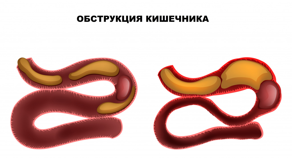 Обструкция кишечника.jpg Обструкция кишечника.jpg