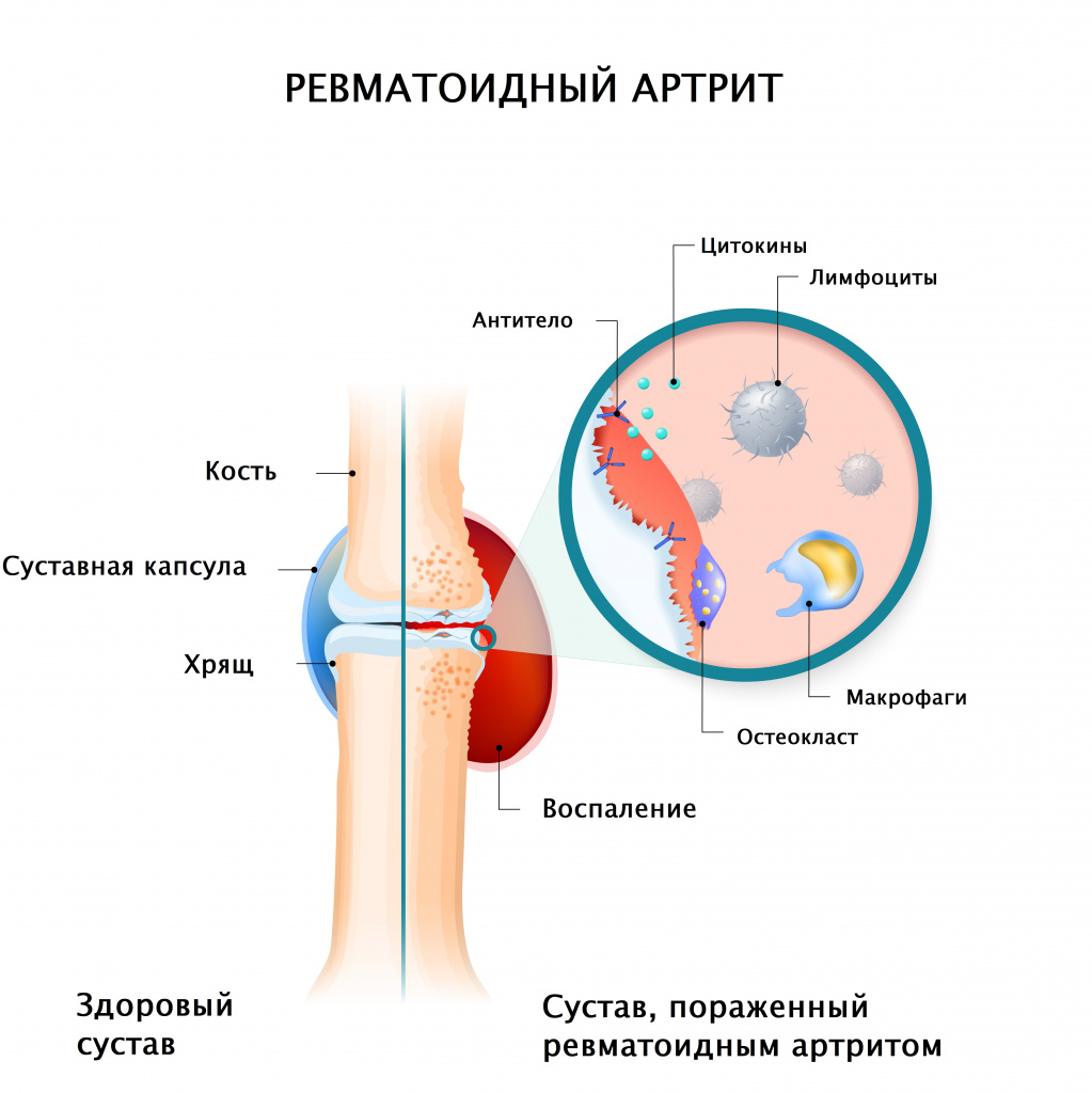 Классификация ревматоидного артрита