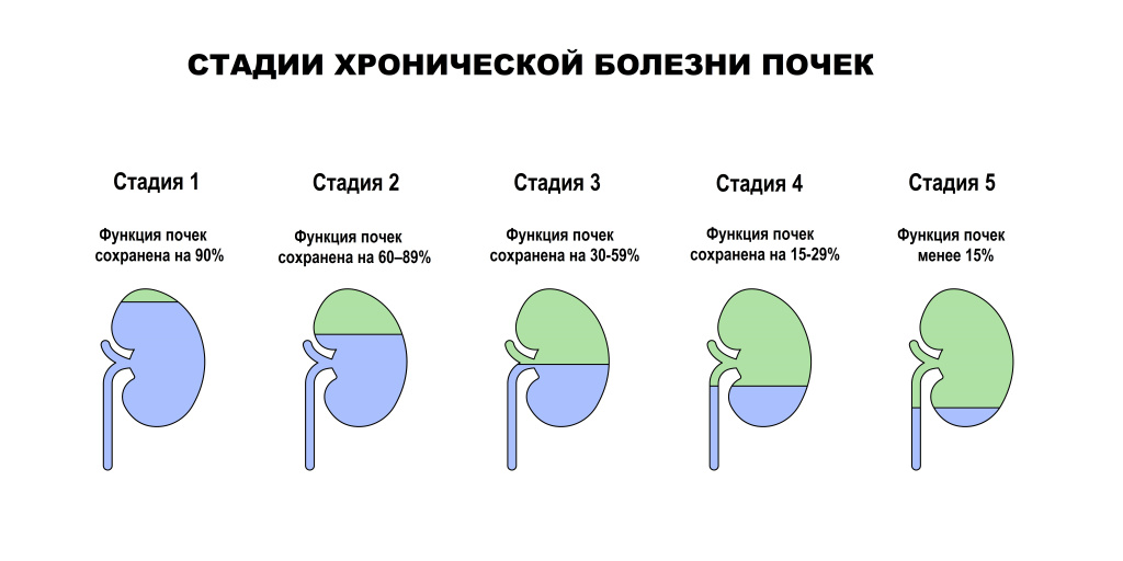 Стадии ХБП.jpg