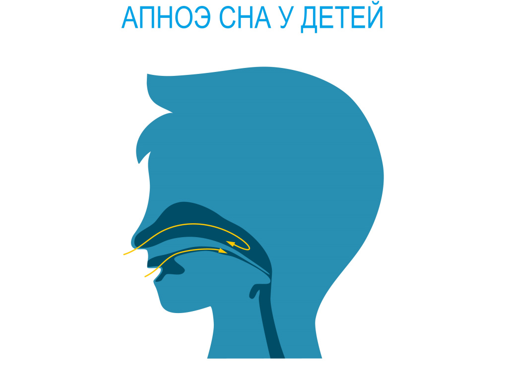 Апноэ_дети.jpg