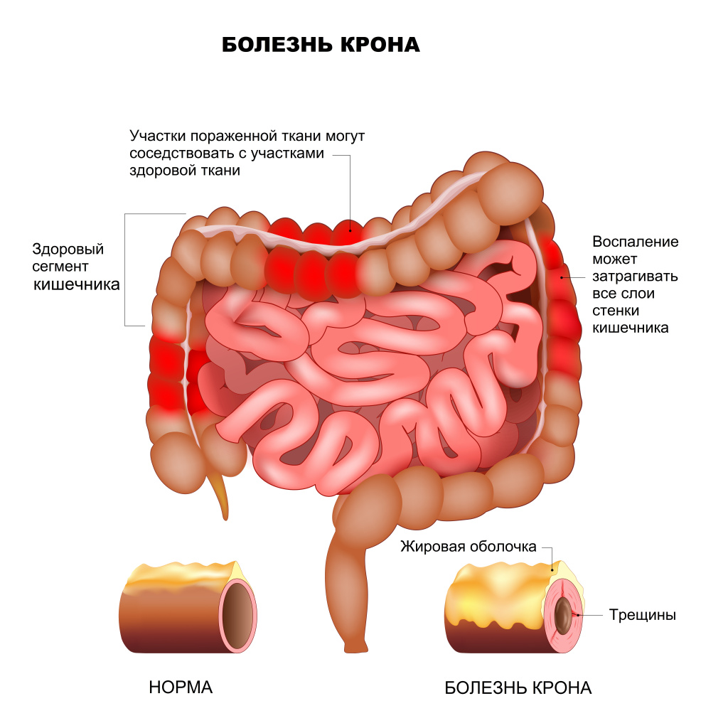 Крон у детей.jpg