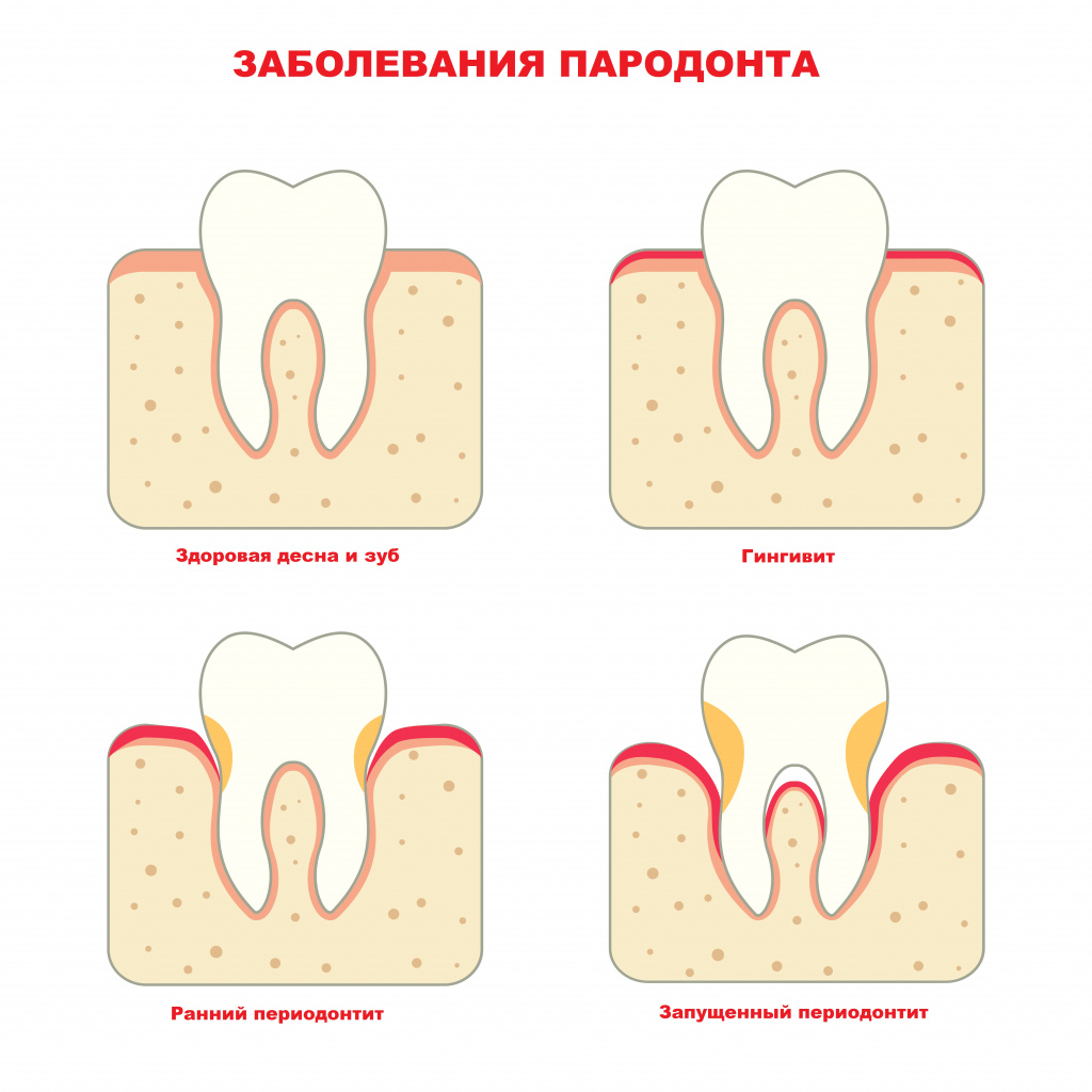 Болезни зубов и их названия