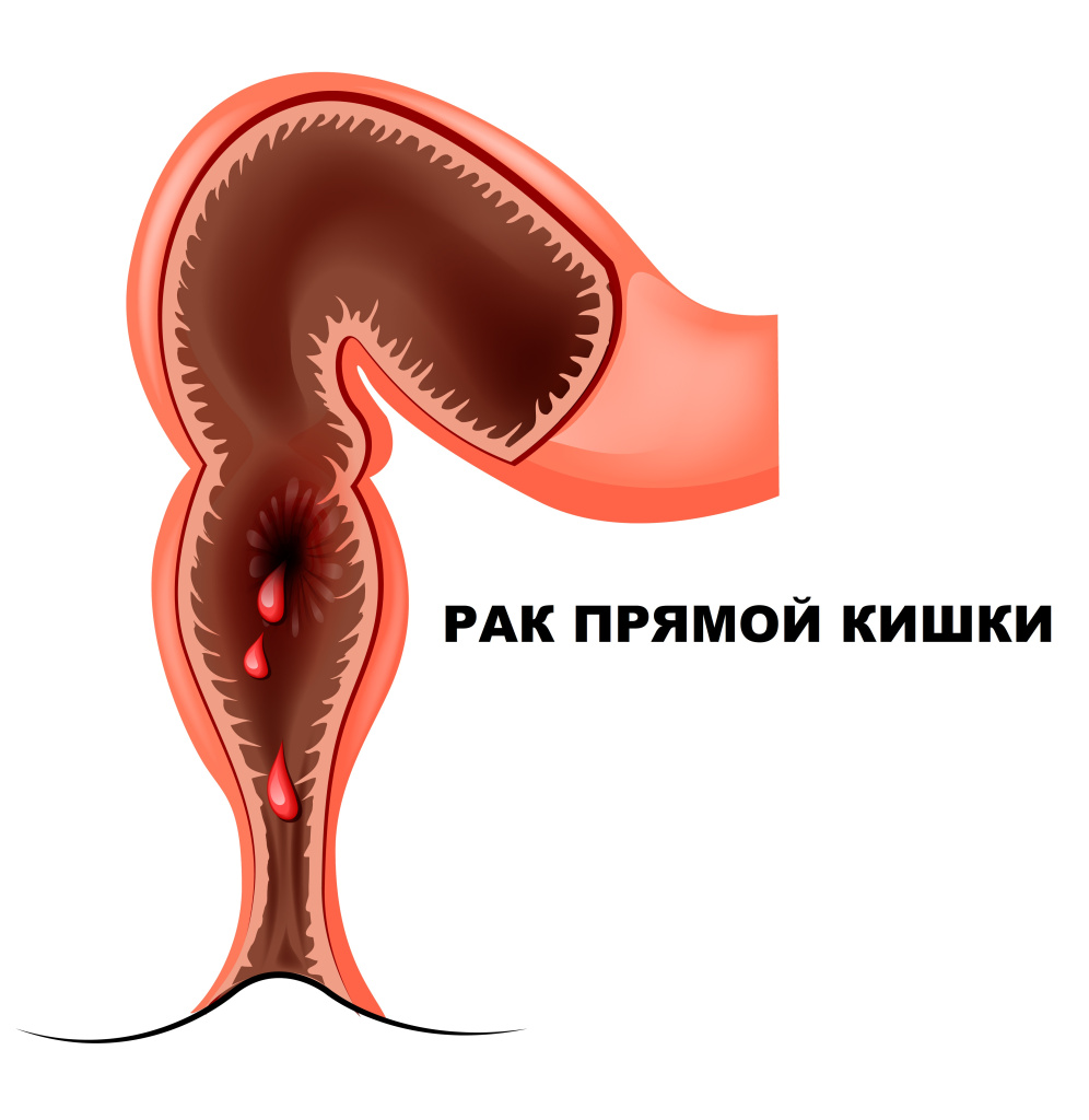 Рак прямой кишки.jpg