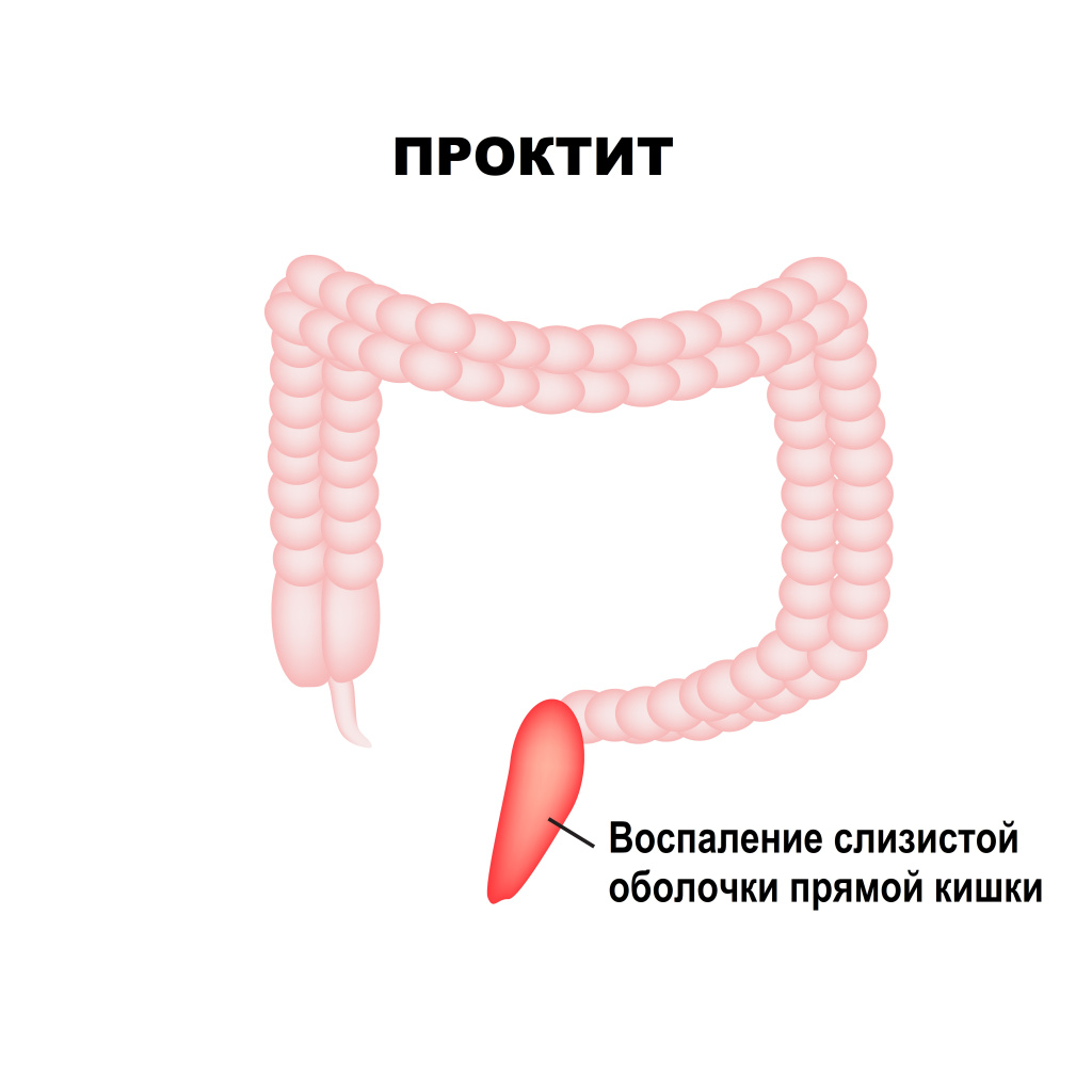Проктит.jpg Проктит.jpg