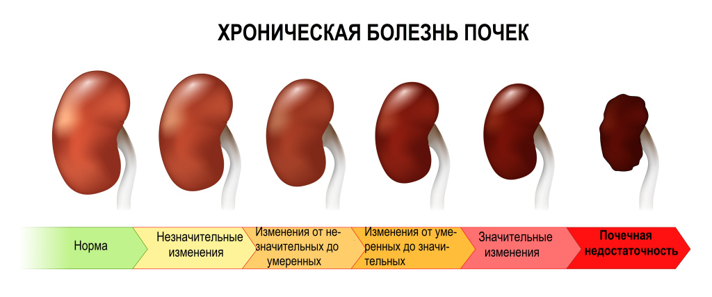 Нефропатии.jpg