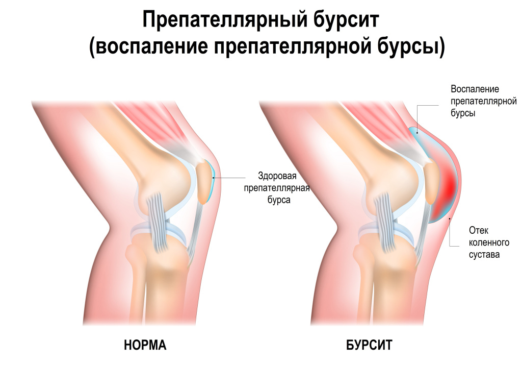 Бурсит.jpg