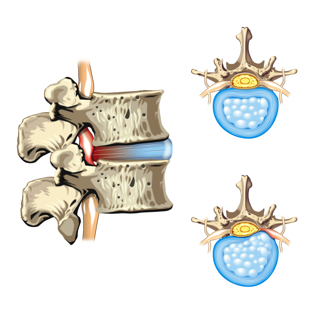 Боль в мышцах спины - причины появления, при каких заболеваниях возникает, диагностика и способы лечения