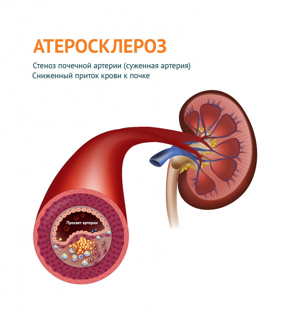 Атеросклероз почечной артерии.jpg