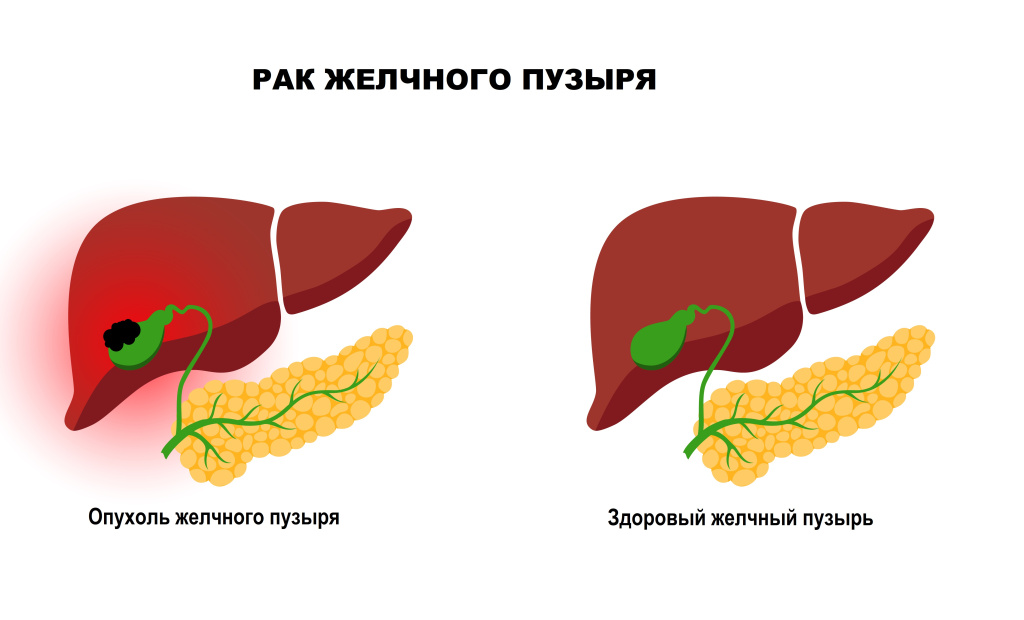 рак желчного пузыря.jpg