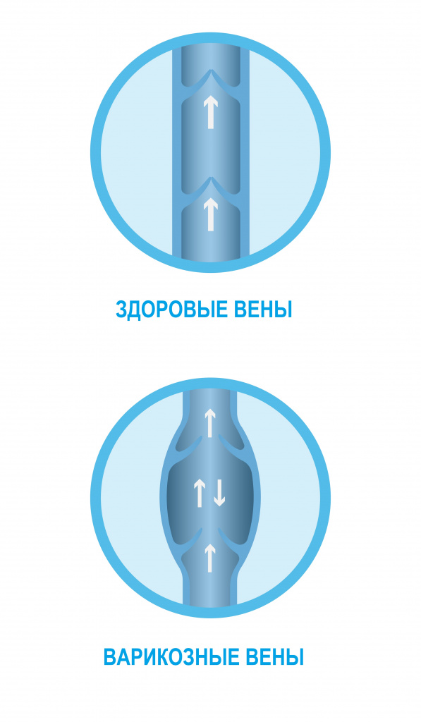 Здоровые и варикозные вены.jpg