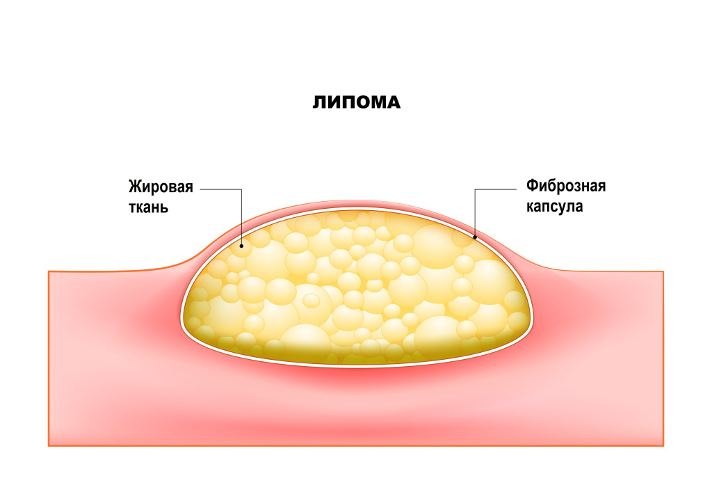 Липома.jpg