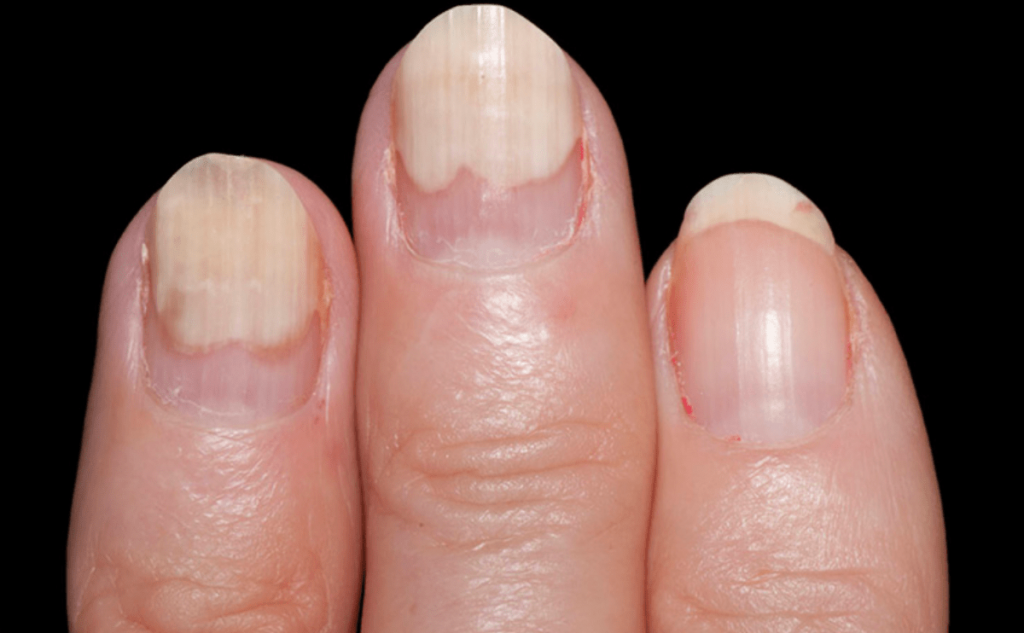 Онихолизис ногтей – причины, симптомы, лечение и профилактика