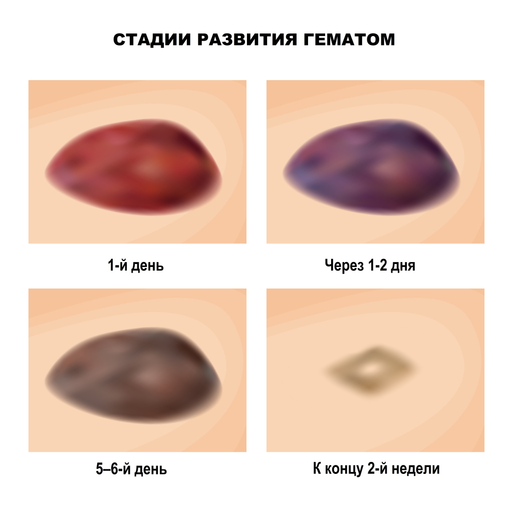 Гематома.jpg