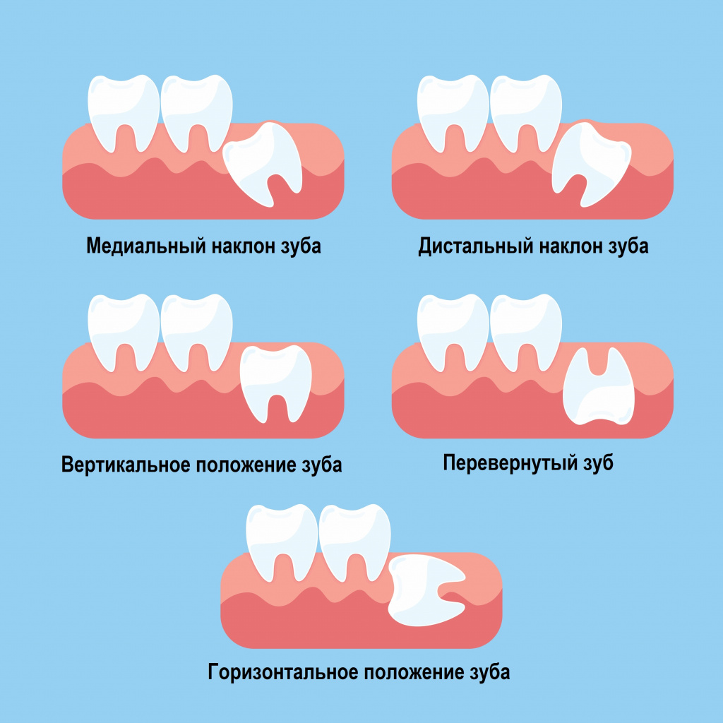 Удаление зуба Томск Заречная 3-я администрация томской
