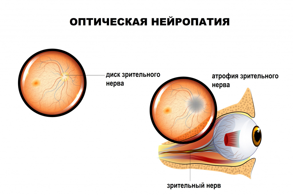 Зрительный нерв.jpg