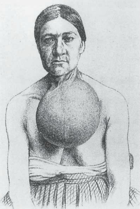 Женщина с зобом.jpg Женщина с зобом.jpg